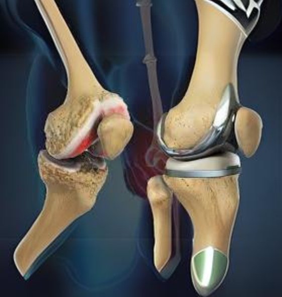 Knee Replacement Surgery to Grab The Chance Of Mobility