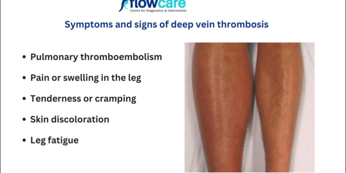 Understanding the Signs of DVT in Leg: Key Symptoms to Look Out For