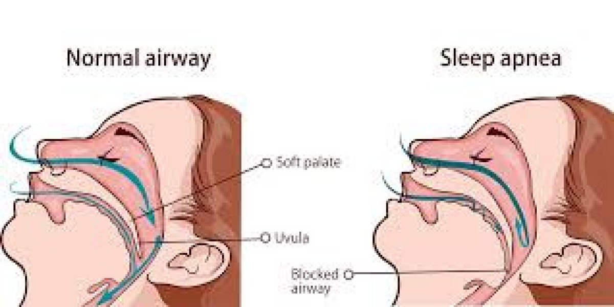 Can Aspadol 100 mg (Nucynta) Help Manage Pain in Patients With Sleep Apnea?